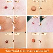 Skin Tag Remover Kit