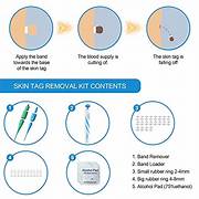 Skin Tag Remover Kit